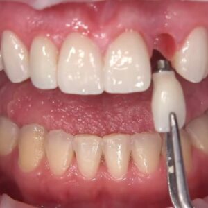 Implantes de carga inmediata
