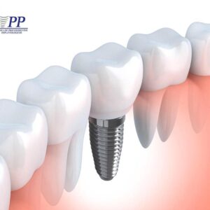 Implantes dentales