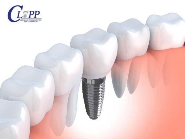 Implantes dentales