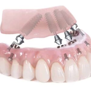 Implantes All-on-4